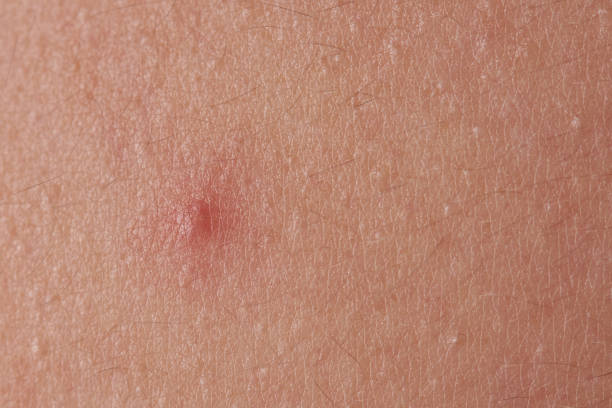 istock Red pimple on human skin 949808984
