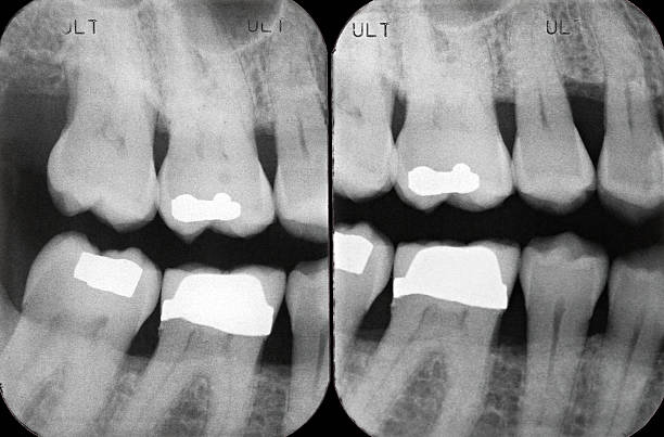 左の歯周 x 線 - 歯 写真 ストックフォトと画像