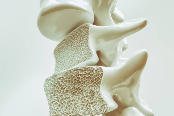 osteoporose an der wirbelsäule - 3d rendering - osteoporose stock-fotos und bilder