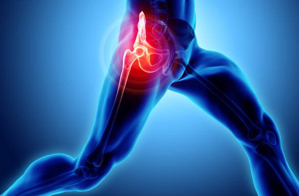 hüfte schmerzhaft skelett röntgen, 3d illustration. - hip replacement stock-fotos und bilder