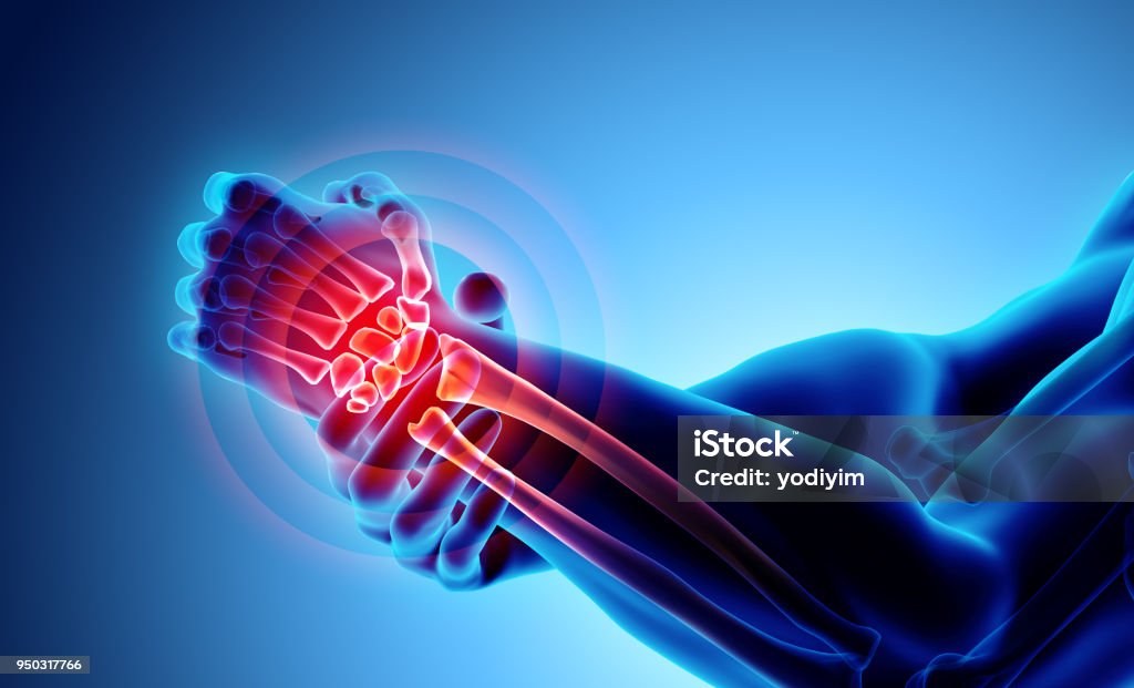 Wrist painful - skeleton x-ray. Wrist painful - skeleton x-ray, 3D Illustration medical concept. Wrist Stock Photo