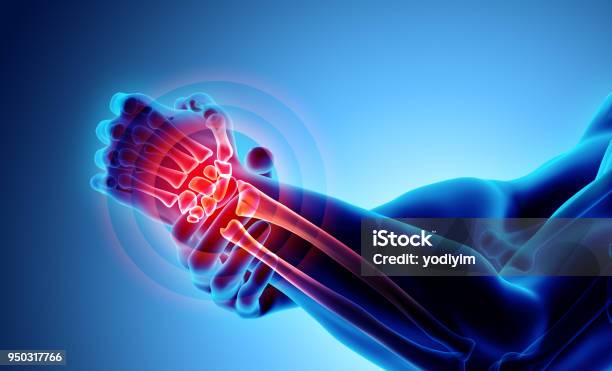 Wrist Painful Skeleton Xray Stock Photo - Download Image Now - Wrist, Pain, X-ray Image