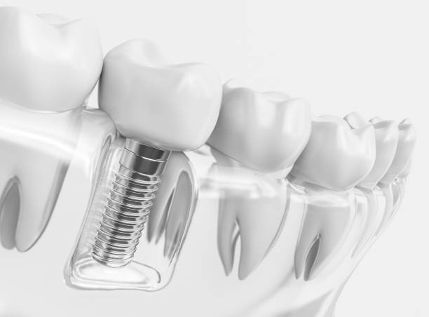 Tooth human implant - 3D Rendering Tooth human implant. Dental concept. Human teeth or dentures. 3d rendering titanium stock pictures, royalty-free photos & images