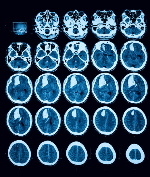 Computed tomography (CT) scan of the brain without intravenous contrast administration, tranvers view Showing intraparenchymal hematoma of right frontal lobe hematoma images stock pictures, royalty-free photos & images