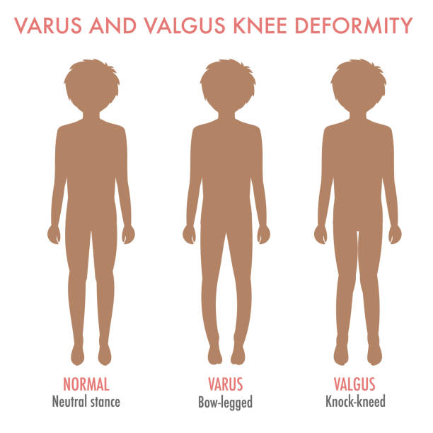Varus Def 40+ Varus Deformity Of Heel Stock Photos, Pictures & Royalty-Free ...