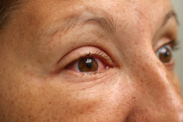 une femelle mettant médecine des yeux dans les yeux - conjunctivitis sore eyes child human eye photos et images de collection