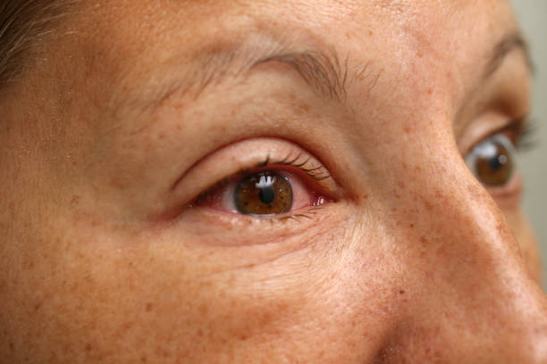 istock A female putting eye medicine in her eyes 950762488