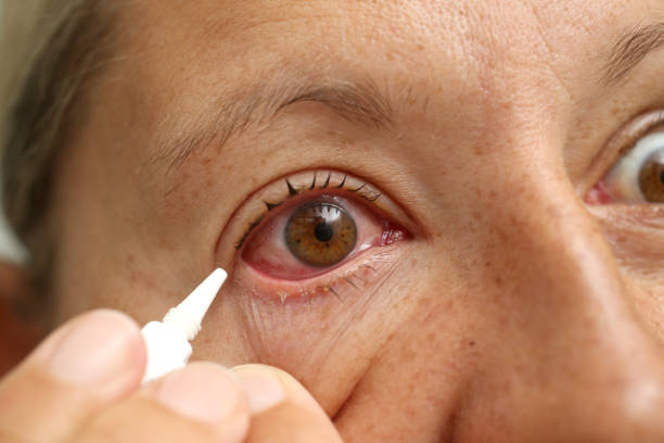 kobieta wkładająca lek do oczu w oczy - conjunctivitis sore eyes child human eye zdjęcia i obrazy z banku zdjęć