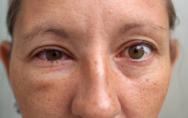 그녀의 눈에 안 약을 넣어 여성 - conjunctivitis sore eyes child human eye 뉴스 사진 이미지