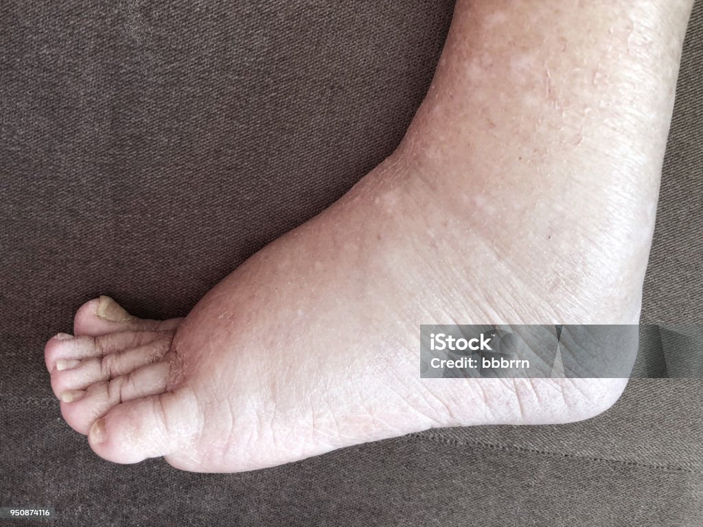 Foot of diseased female patient who suffers from edema illness Closeup foot of diseased female patient who suffers from edema illness Edema Stock Photo