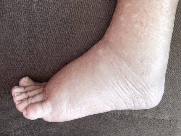 Foot of diseased female patient who suffers from edema illness stock photo