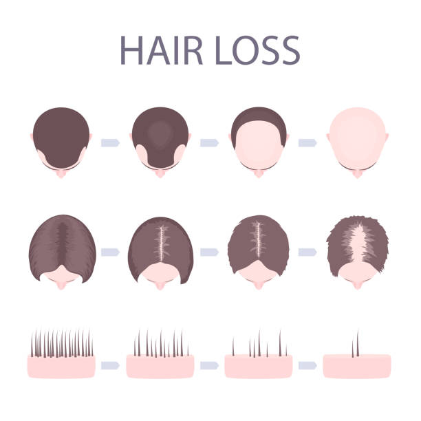 ilustrações, clipart, desenhos animados e ícones de perda de cabelo masculino e feminino - alopecia antes depois
