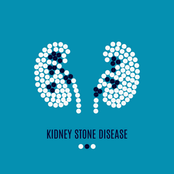 illustrazioni stock, clip art, cartoni animati e icone di tendenza di poster delle pillole per la malattia dei calcoli renali - kidney stone