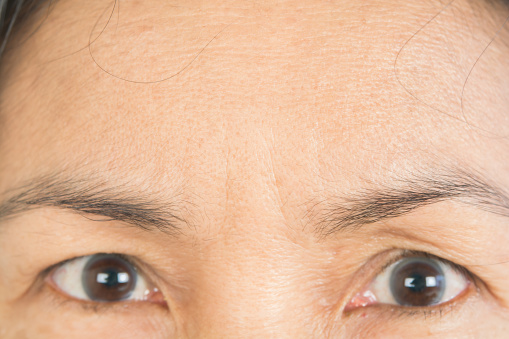 Wrinkles on the forehead in old women
