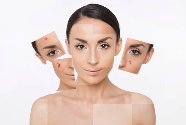Problem skin of face. Part of face Problem skin of face. Part of face. Beauty woman collage. Portrait of a beautiful young smiling woman with fresh and clean skin. Skin care. Cosmetology. Women Health skin diagram photos stock pictures, royalty-free photos & images