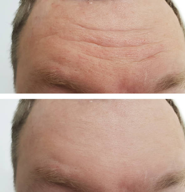 forehead wrinkles man before and after forehead wrinkles man before and after botox before and after stock pictures, royalty-free photos & images