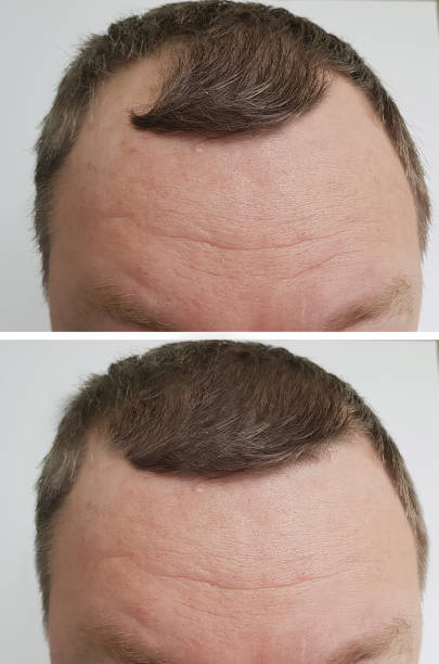 Male Baldness Problem Before And After Stock Photo - Download Image Now -  Change, Hair, Hair Loss - iStock