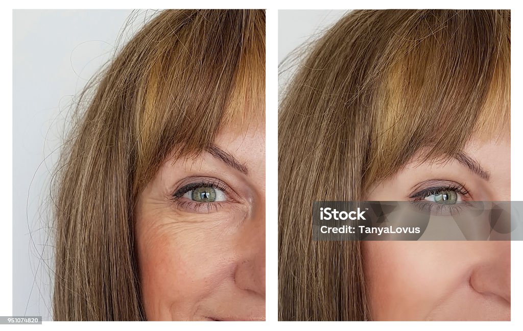 Frau Falten im Gesicht vor und nach - Lizenzfrei Botulinumtoxin-Spritze Stock-Foto