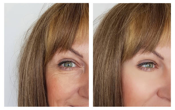 woman face wrinkles before and after woman face wrinkles before and after botox before and after stock pictures, royalty-free photos & images