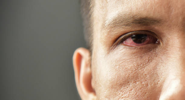 istock Irritated red bloodshot male eye. 951083182