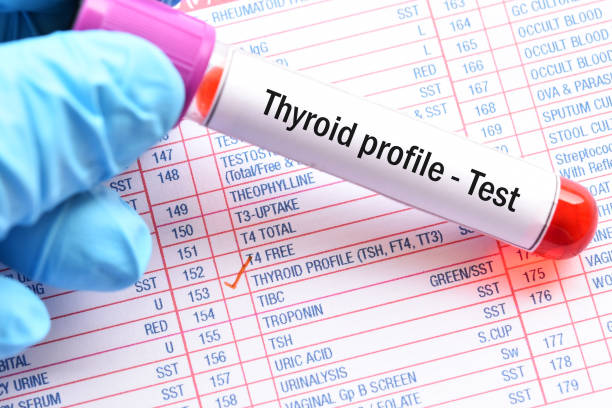 test del profilo tiroideo - goiter foto e immagini stock