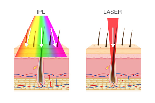 The difference of using IPL light and laser in hair removal. Illustration about beauty technology.