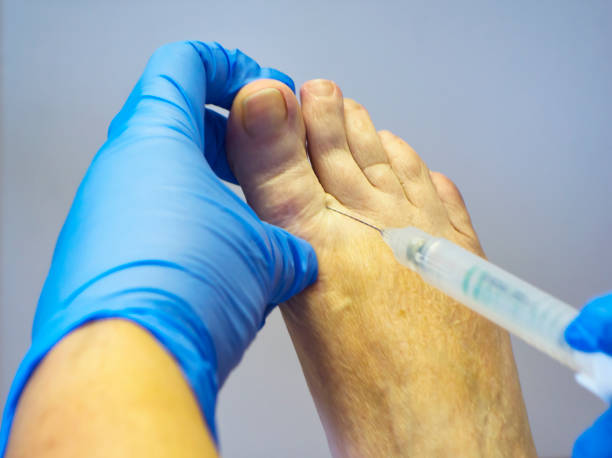 injeção em um dedo do pé - podiatry human foot podiatrist surgery - fotografias e filmes do acervo