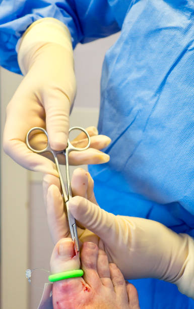 rimozione di parte di un'unghia durante l'intervento chirurgico alle unghie dei piedi incarito - podiatry human foot podiatrist surgery foto e immagini stock