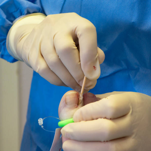 aplicação de fenol durante a cirurgia de unha encravada - podiatry human foot podiatrist surgery - fotografias e filmes do acervo