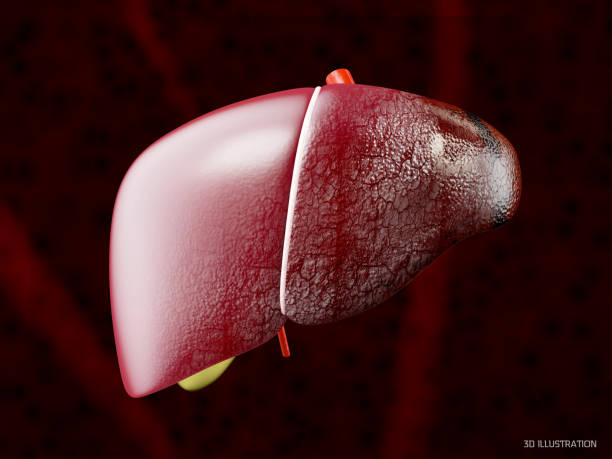 istock Human liver damage anatomy, 3d Illustration 951839466