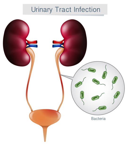 Urinary Tract Infection on White Background Urinary Tract Infection on White Background illustration urinary tract infection stock illustrations