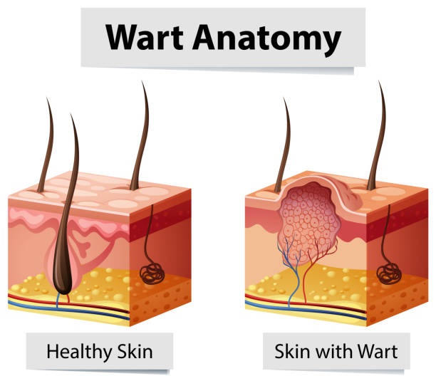Wart Human Skin Anatomy Illustration Wart Human Skin Anatomy Illustration illustration wart stock illustrations