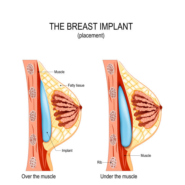 Breast implant placement Breast implant placement. Cosmetic (plastic) surgery. methods of the Submuscular Pocket (under the muscle) and subglandular (over the muscle). silicone implants stock illustrations