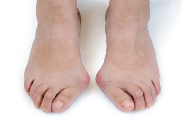 pieds avec oignon (hallux valgus) - misalignment photos et images de collection