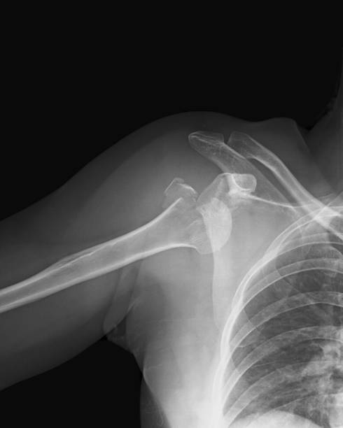 radiographie de l’épaule en collaboration, fron vue - x ray x ray image shoulder human arm photos et images de collection