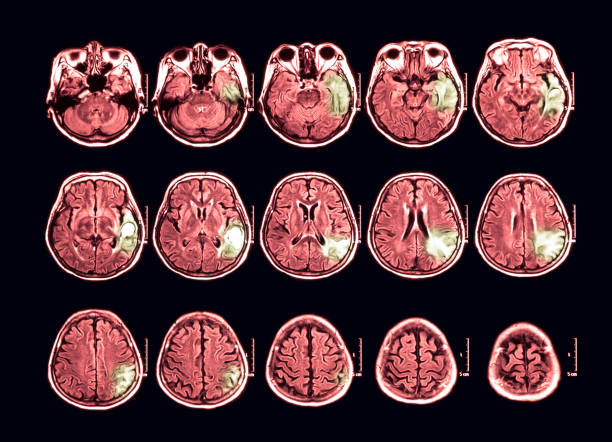 MRI scan of the brain, transverse view Magnetic resonance imaging (MRI) scan of the brain, transverse view, case of hematoma at left temporal lobe atrophy photos stock pictures, royalty-free photos & images