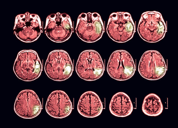 MRI scan of the brain, transverse view Magnetic resonance imaging (MRI) scan of the brain, transverse view, case of hematoma at left temporal lobe hematoma images stock pictures, royalty-free photos & images