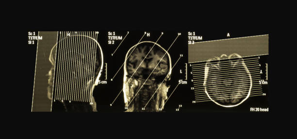 ローカライズすると脳 mri 画像、左側頭葉皮質下に血腫の 1 例 - brain case ストックフォトと画像