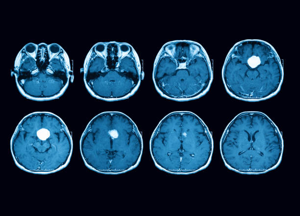 risonanza magnetica (mri) scansione del cervello che mostra massa ipofisaria, vista trasversale - mri scan human nervous system brain medical scan foto e immagini stock