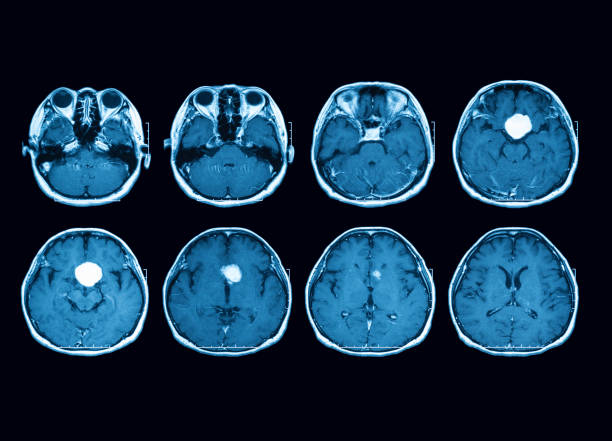 뇌 하 수 체 질량을 보여주는 뇌의 자기 공명 영상 (mri) 스캔 가로 보기 - tumor 뉴스 사진 이미지