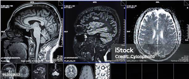 Ct Scans Of Human Head Stock Photo - Download Image Now - CAT Scan, CAT Scan Machine, MRI Scan