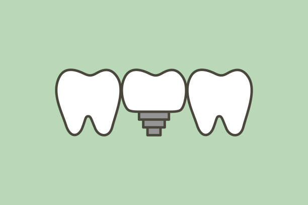 tooth implant, teeth change new root tooth implant, teeth change new root - dental cartoon vector flat style cute character for design cute cartoon dental implants stock illustrations
