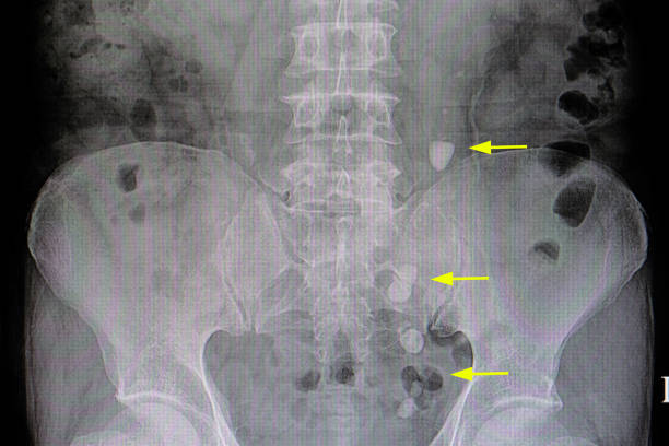 ureteric stones xray film of a patient with several ureteric stones or calculi in mid and lower left ureter ureter stock pictures, royalty-free photos & images