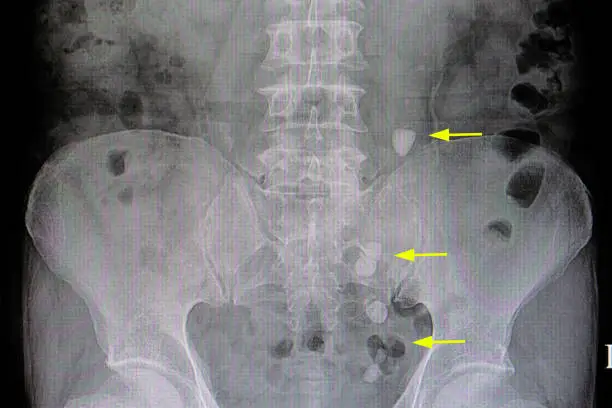 Photo of ureteric stones