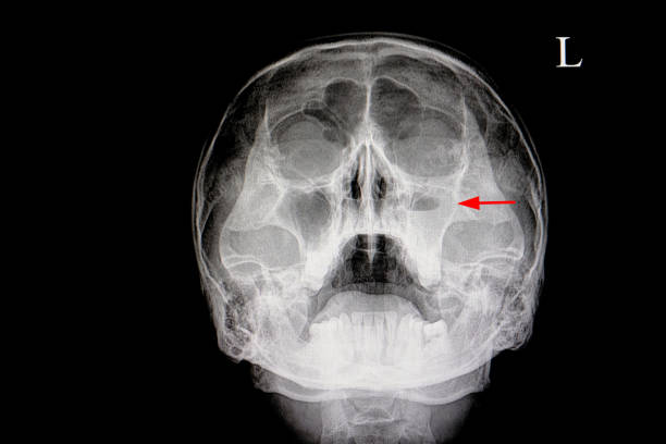 un paciente con sinusitis maxilar aguda - acute mountain sickness fotografías e imágenes de stock