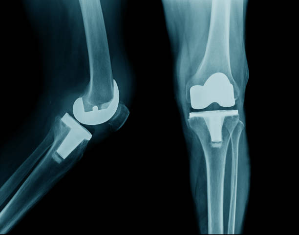 istock x-ray hip replacement or total knee arthroplasty AP and lateral view 952704568