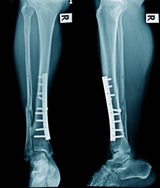 istock x-ray image of leg show internal fixation at tibia bone 952704630
