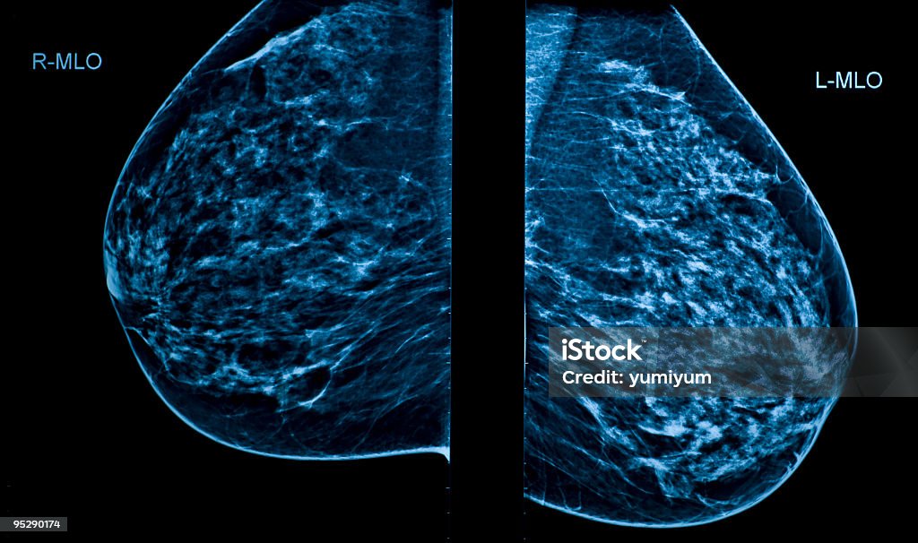 A Mammogram image showing left and right breasts Mammogram Mammogram Stock Photo