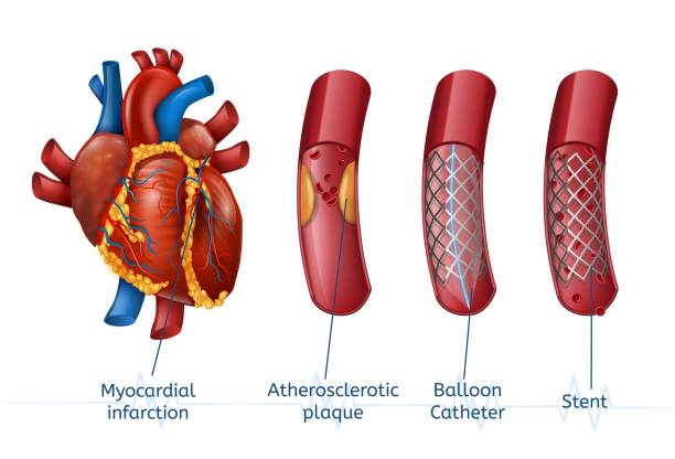 ilustraciones, imágenes clip art, dibujos animados e iconos de stock de infarto del miocardio. 3d realostic stent en el corazón - angioplasty