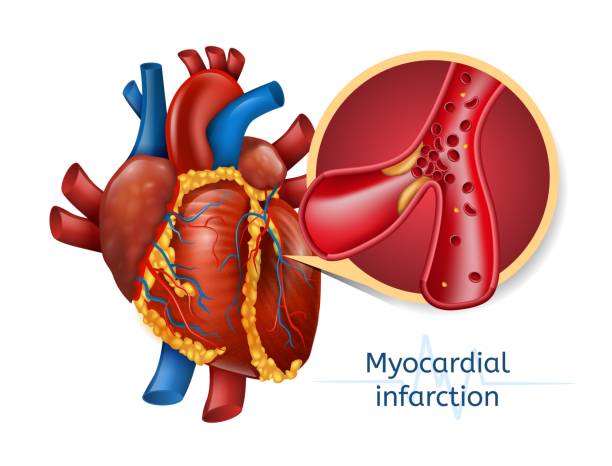 ilustrações de stock, clip art, desenhos animados e ícones de myocardial infarction. 3d realostic heart - pumping blood illustrations